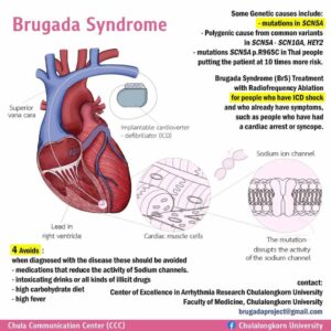 Brugada Syndrome.