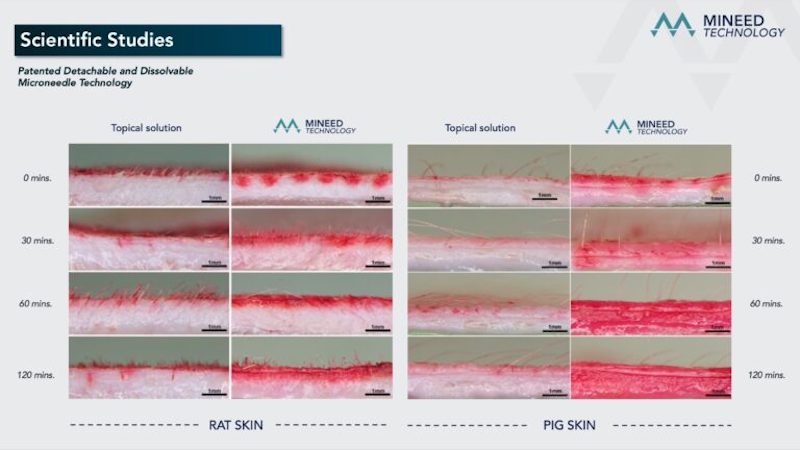 Soluble microneedles